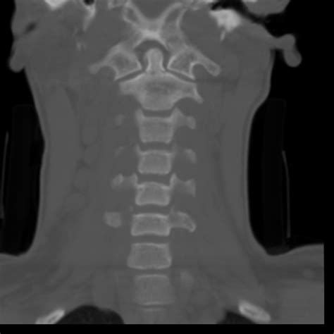 C Spine Injuries Ct Interpretation Core Em