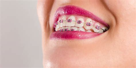 Aparelho Dentário Saiba O Que é E Conheça Os Modelos Uniodonto Rs
