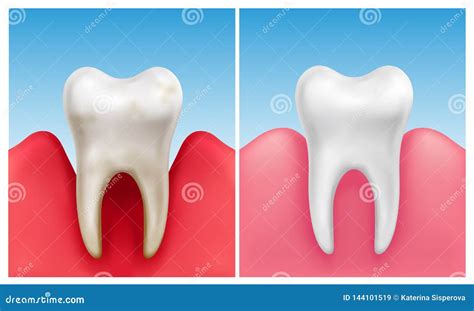 Vector Illustration Of Gum Disease Periodontitis In Compare With