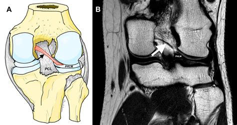 Clinical Anatomy Of The Posterior Meniscofemoral Ligament Of Wrisberg An Original MRI Study
