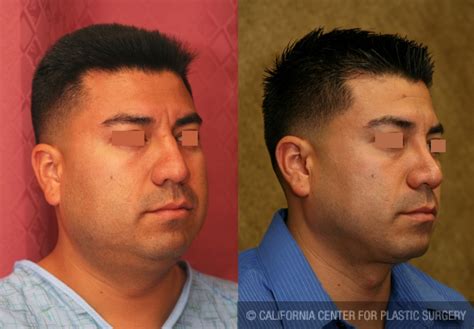 I have recurved many compliments from friends and people from work places. Patient #6418 Male Rhinoplasty Before and After Photos ...