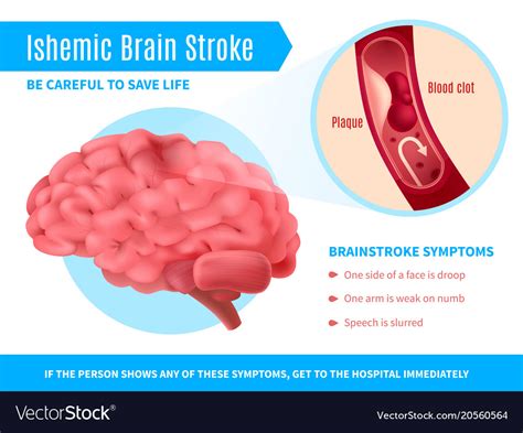 Ischemic Brain Stroke Poster Royalty Free Vector Image