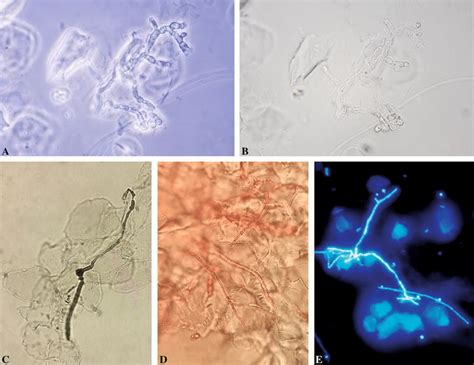 Direct Examination Of Nail Fragments Showing Septate Hyphae By