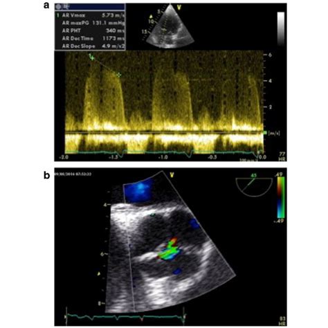 Echocardiography Severe Aortic Valve Regurgitation A Cw Doppler B