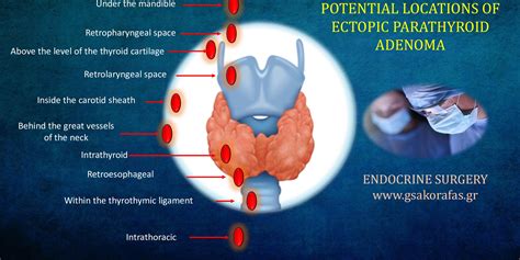 Ectopic Parathyroid Adenoma Clinical Importance 9 0 6