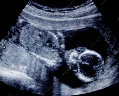 Thirteen Week Old Foetus Ultrasound Scan Stock Image P6800814