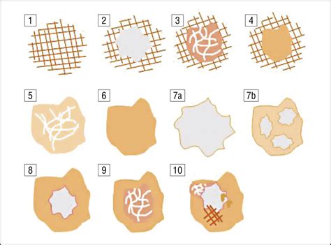 Dermoscopy Of Dermatofibromas A Prospective Morphological Study Of 412