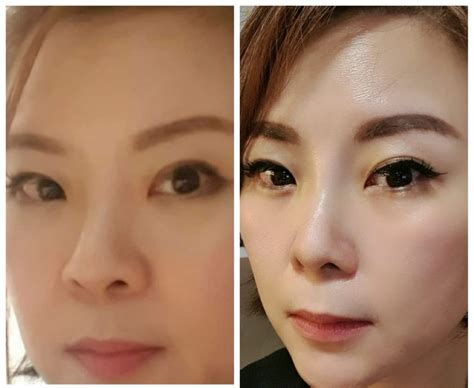 My Hiko Nose Thread Lift Review Before After Photos Included