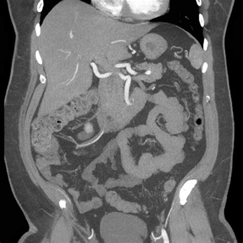 Abdominal Wall Muscles Normal Anatomy Coronal CT Of