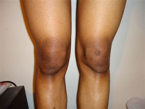 All 2 Women 5 Wonderful Ways To Remove Dark Elbows And Knees Natural