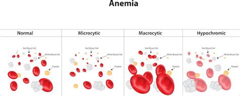 Anemia can make you short of breath; macrocytic-anemia.jpg | Health Testing Centers