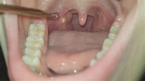 More Tonsil Stones Youtube