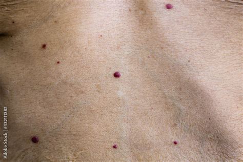 Red Moles Or Cherry Angiomas Are Common Skin Growths That Can Develop