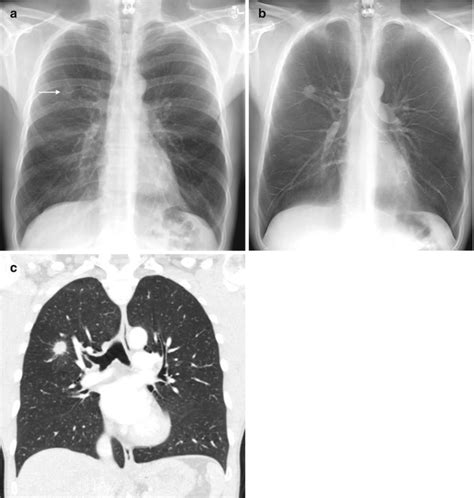 Fig 18 Solitary Pulmonary Nodule With Spiculation Diseases