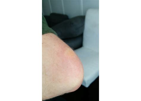 Dermatology Itchy Miscolored Inflammed Bump On Elbow Medical