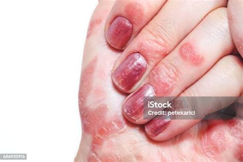 Psoriasis Hand Stock Photo Download Image Now Psoriasis Fingernail