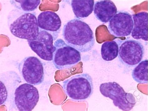 T Cell Prolymphocytic Leukemia 5