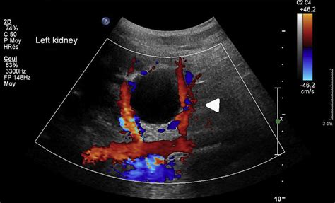 Colour Doppler Renal Ultrasound Left Kidney Longitudinal View