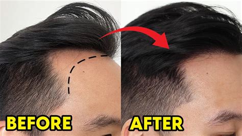 Hair Transplant Before After Year Results Youtube
