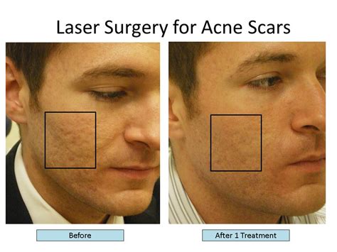 The Best Lasers To Treat Acne Scars Fractional Co Laser Fraxel