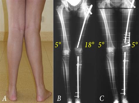 Surgical Correction Of Valgus Deformities Of The Knee In Polyostotic