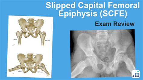 Slipped Capital Femoral Epiphysis Scfe Exam Review William Jiranek