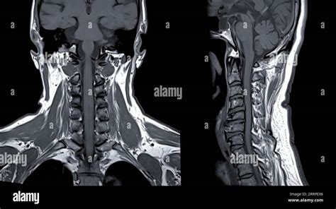 Mri Of C Spine Or Magnetic Resonance Image Of Cervical Spine Coronal