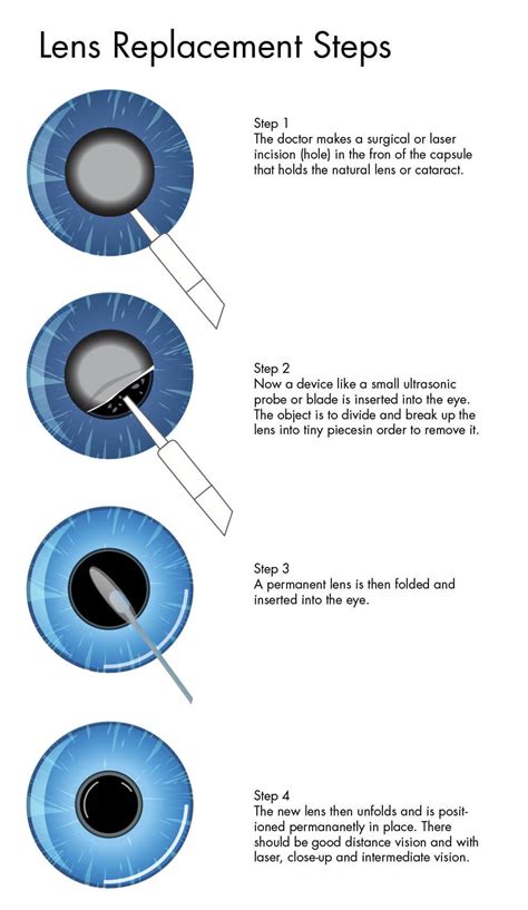 Explain Different Types Of Cataract Surgery