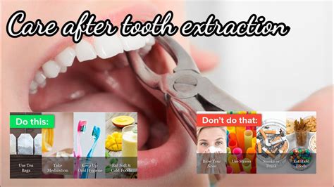 Tooth Extraction Aftercare Tips To Heal Successfully Youtube
