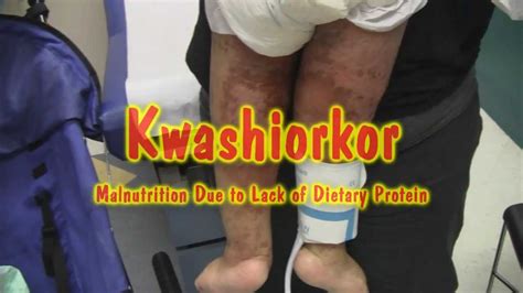 It is very easy to prevent kwashiorkor in areas where there is no famine. Kwashiorkor - YouTube