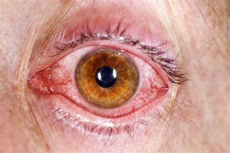 Viral Conjunctivitis Stock Image C0269241 Science Photo Library