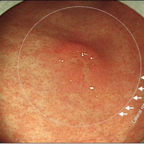 A Small Gastric Erosion On Greater Curvature Of Proximal Antrum On Download Scientific