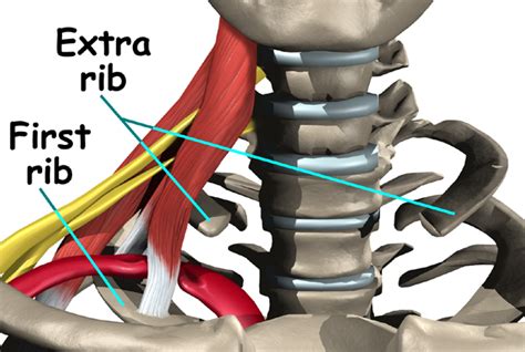 Cervical Ribs And Thoracic Outlet Syndrome