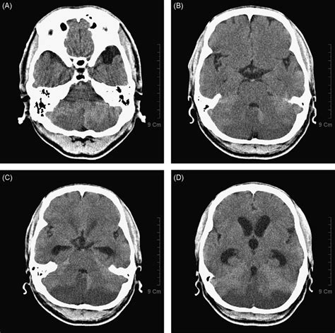 A And B Non Contrasting Brain Ct 12 H After Onset Showing Typical