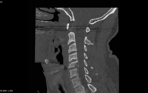 Burst Fracture Cervical Spine Radrounds Radiology Network