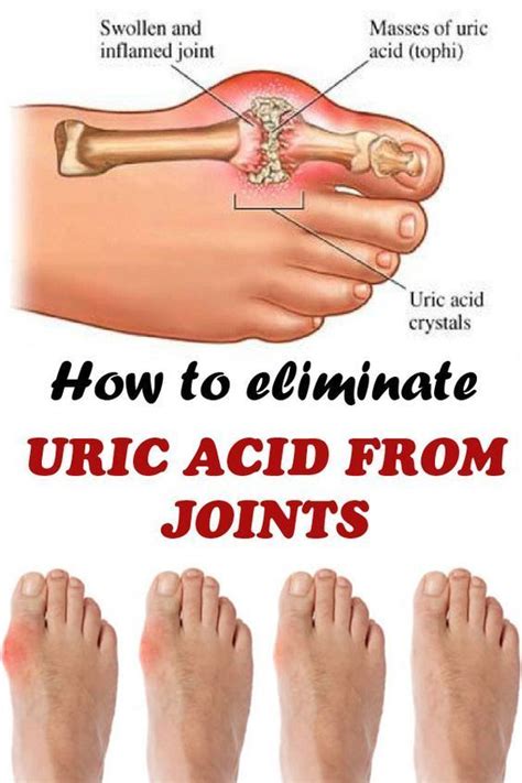 How To Quickly Remove Uric Acid Crystallization From Your Body To