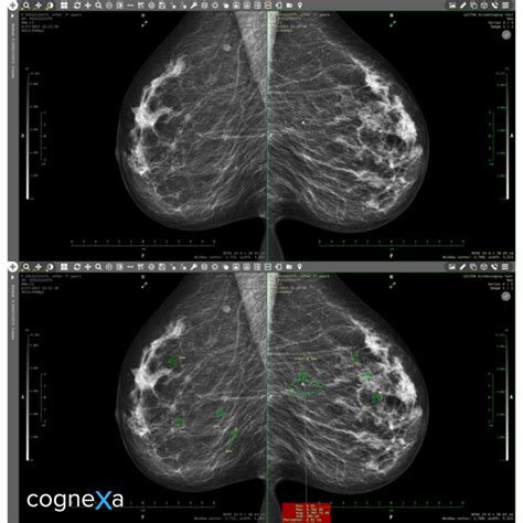 Analysis Of Visual Mammographic Examinations For Radiology Cognexa Com