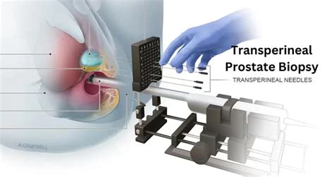What Is A Transperineal Prostate Biopsy Revealing The Procedure Recovery And Benefits