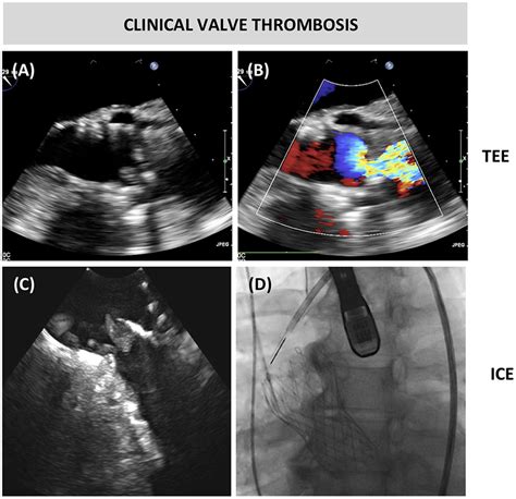 Clinical Valve Thrombosis Ab Transesophageal Echocardiography