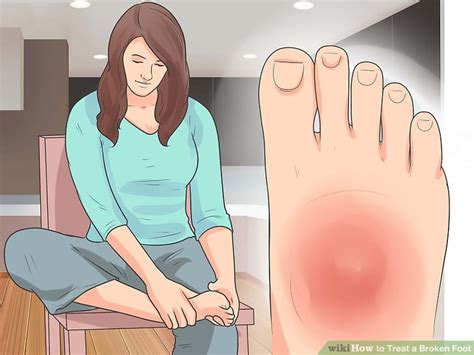This is a sprained 5th toe. 4 Ways to Treat a Broken Foot - wikiHow