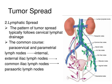 Cervical Cancer Lymph Nodes