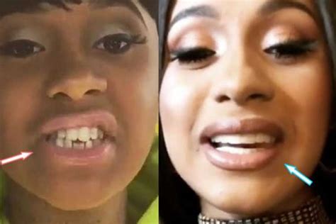 Cardi B Teeth Before And After Cost Surgery Pictures