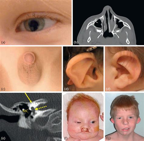 Charge Syndrome Causes Symptoms Diagnosis Life Expectancy And Treatment
