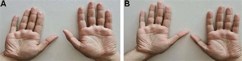Superior Clinical Image A Shows Diffuse Palmar Hyperhidrosis In A