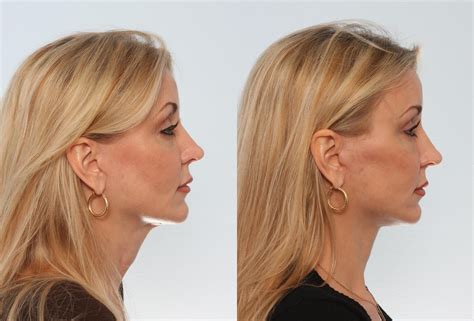 Neck Lifts Before And After Pictures Before And After