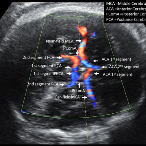 Middle Cerebral Artery MCA Doppler Waveforms Obtained From The