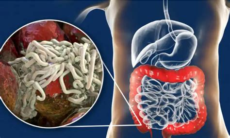 Infecci N Intestinal Por Oxiuros