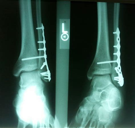 My Ankle After Recent Surgery To Fix A Fibia Spiral Fracture To The
