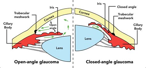 Angle Closure Glaucoma Vs Open Angle
