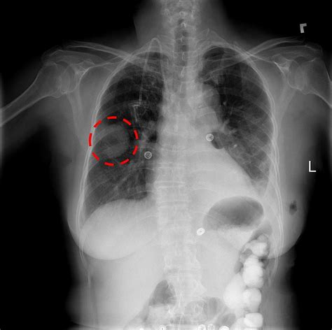 However some patients, who have an acute cardiac infarction, may still have a normal heart size, while other patients who have a large heart due to a chronic heart disease, may. Chest x-ray showing a lung mass | September 2017: The NIH ...